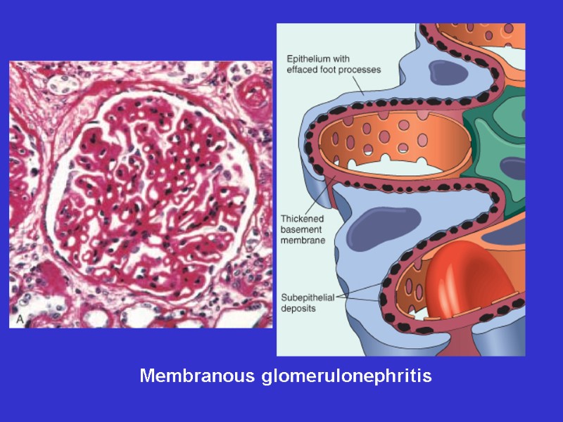 Membranous glomerulonephritis